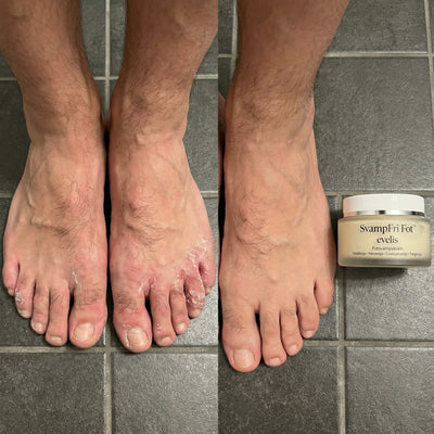 SvampFri Fot™ - fotsvampskräm