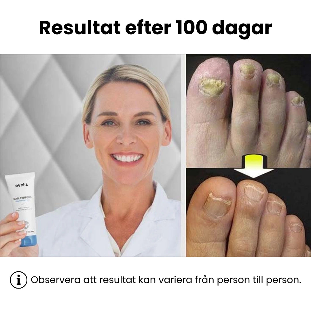 Nagelsvamp gel