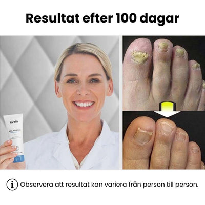 Nagelsvamp gel
