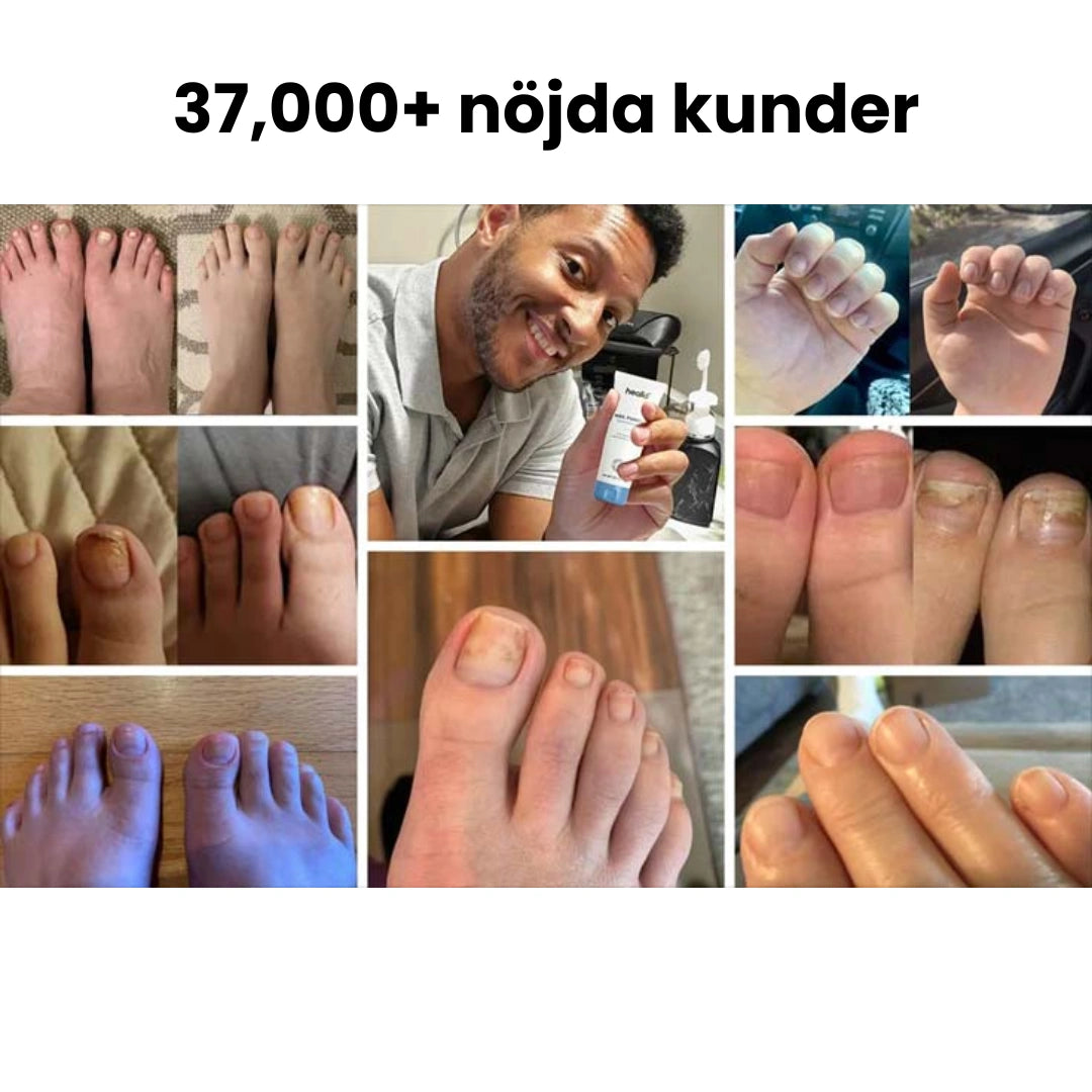 Nagelsvamp gel