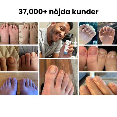 Nagelsvamp gel